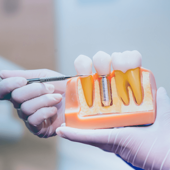 dental implants in Whitby