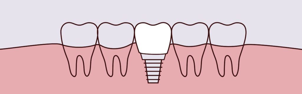 dental implants dentist in Whitby Ontario