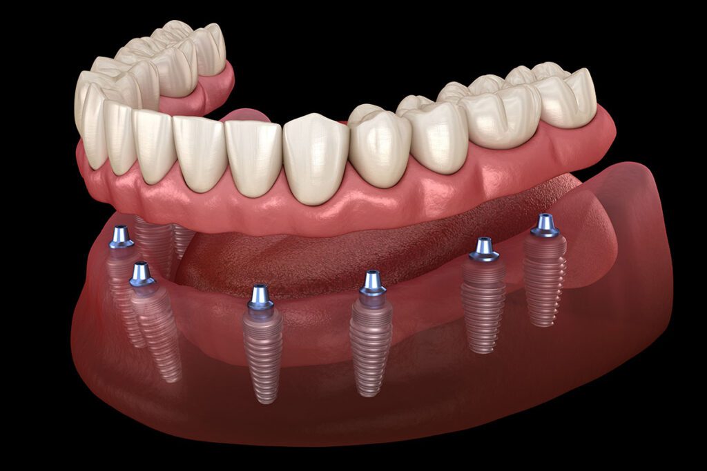Hybrid Prosthesis dental implants Whitby